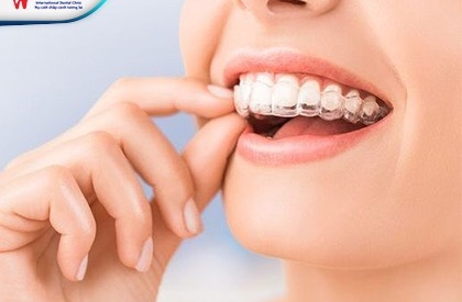 Niềng răng trong suốt