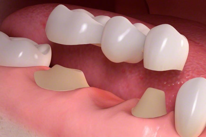 Phương pháp làm cầu răng còn nhiều nhược điểm, hạn chế, gây hại cho răng kế bên